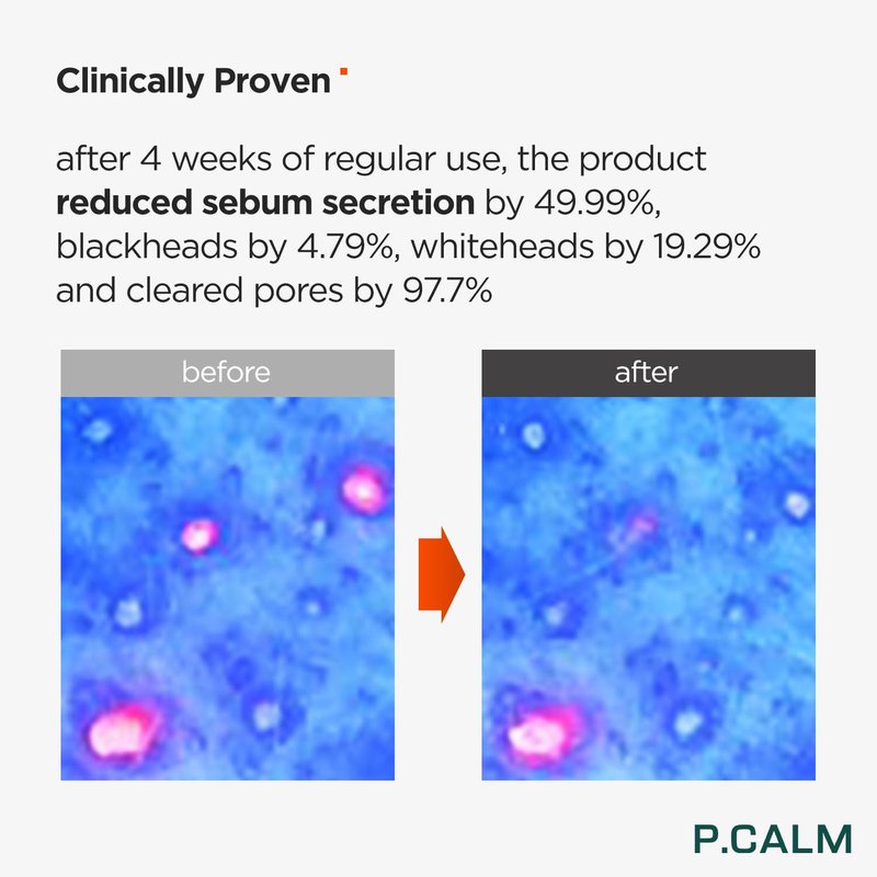 P.CALM Underpore Foam Cleanser | Azulene for Deep Pore Cleansing, Gentle Oil Control, Mild & Non-Irritating for Sensitive Skin, Foaming Facial Wash | Korean Vegan Skincare, 150ml / 5.07 fl. oz