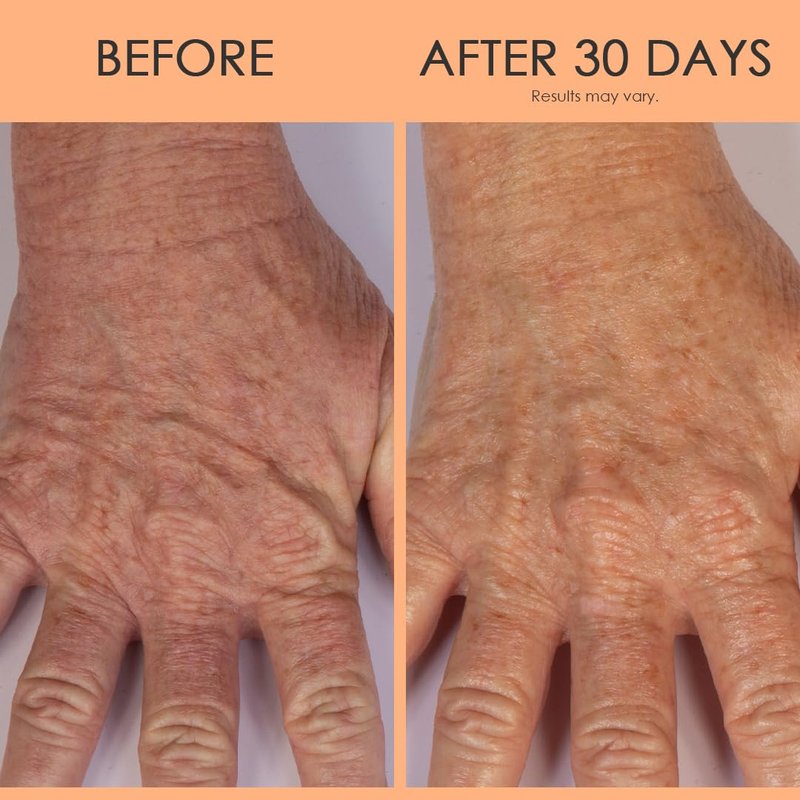 BODY FIRM Crepe Erase Hand Repair Treatment, Anti-Aging Hand Treatment, Lotion with Moisturizing Shea Butter, Vitamin E and Squalane for Cracked, Dry Hands, Supports Wrinkle on Hands, 3 fl oz