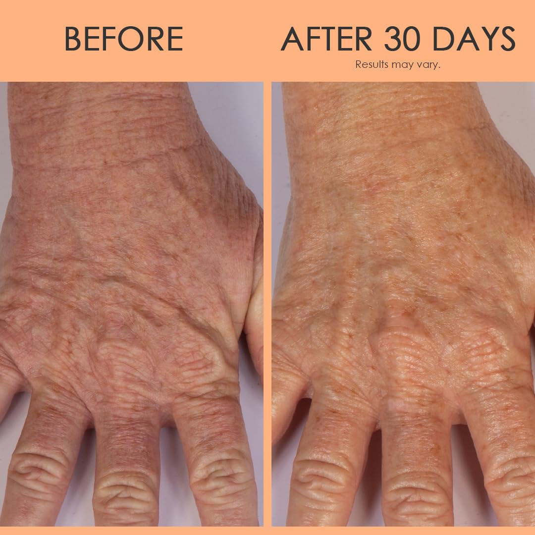BODY FIRM Crepe Erase Hand Repair Treatment, Anti-Aging Hand Treatment, Lotion with Moisturizing Shea Butter, Vitamin E and Squalane for Cracked, Dry Hands, Supports Wrinkle on Hands, 3 fl oz
