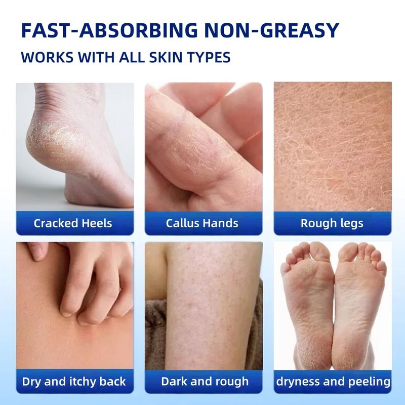 JYOVQXF 40% Urea Foot Cream with 2% Salicylic Acid Dry, Cracked Heel Treatment Callus Remover for Feet, Hands, Elbows Knees Tea Tree, Aloe Hyaluronic Acid Moisturizing Formula, 5.29 oz