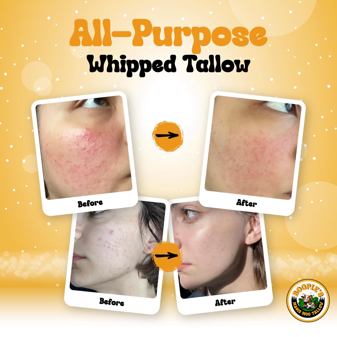 Magic Moo All Purpose Whipped Beef Tallow Skincare for Acne, Eczema, Dry Skin, Moisturizer, Stretch Marks & Hydration. Suet Tallow for Face with Organic Emu Oil. Contains All Organic Ingredients, 4oz