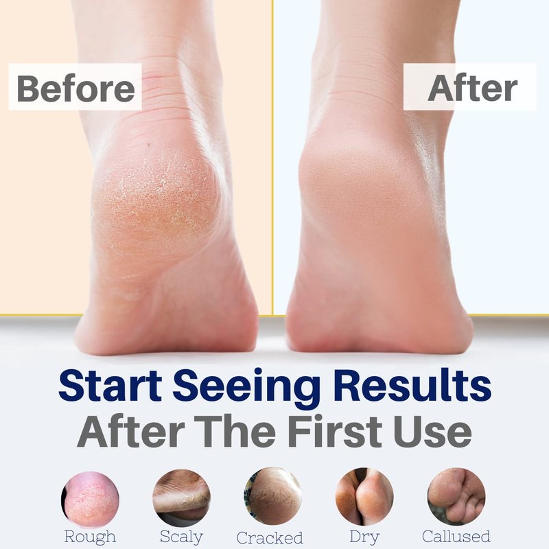 Hydrating Tea Tree Oil Foot Cream - Natural Athlete's Foot Treatment & Moisturizer | 2 oz