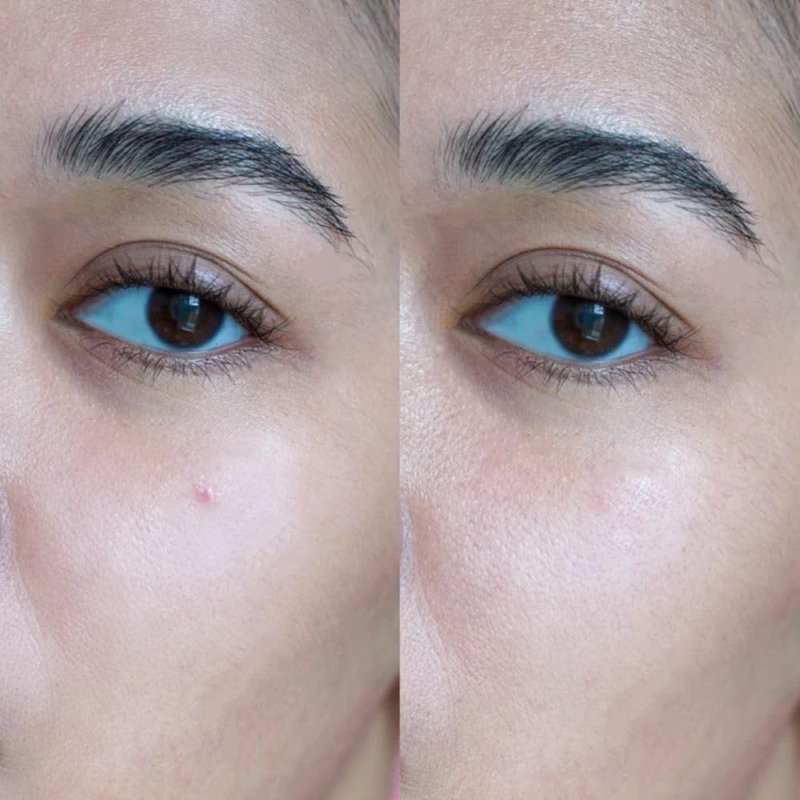 SKIN INC Deepcare Blemish SOS Pimple Patches - Overnight Acne Spot Treatment with Micro Dart Technology | Tea Tree & Salicylic Acid