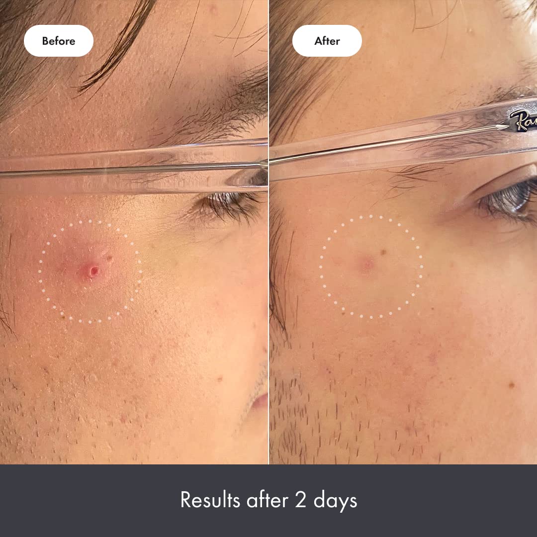Rescue Balm Post-Blemish Recovery Cream from Hero Cosmetics - Intensive Nourishing and Calming for Dry, Red-Looking Skin After a Blemish - Dermatologist Tested and Vegan-Friendly