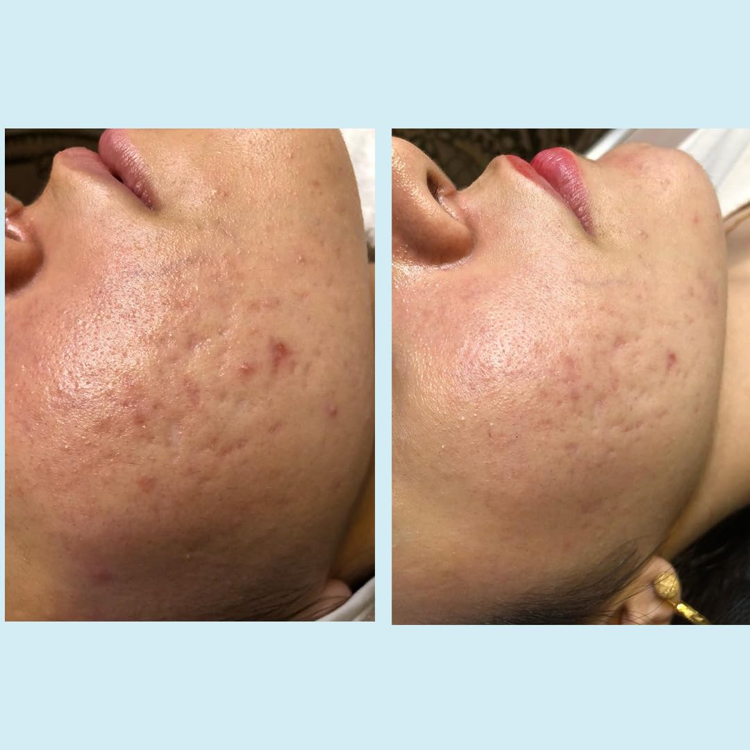 Salicylic Gel Chemical Peel - Enhanced with Green Tea Extract and Tea Tree Oil
