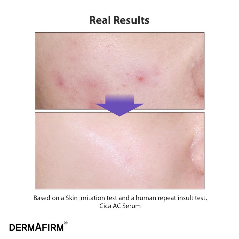 Dermafirm CICA AC Serum for Acne-Prone Skin - Hydrating Korean Facial Serum with Exosome, Centella Asiatica, Niacinamide & Salicylic Acid | 1.01 fl oz