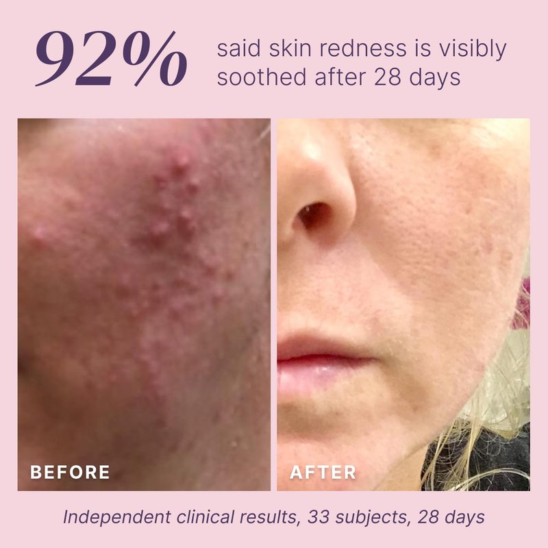 Glycolic Acid Peel 40% Professional Chemical Peel for Face at Home - Intense Alpha Hydroxy Acid Skin Peel For Acne Scars, Collagen Boost, Wrinkles Fine Lines - Liquid Exfoliant Face Peel Mask, 1 Fl Oz