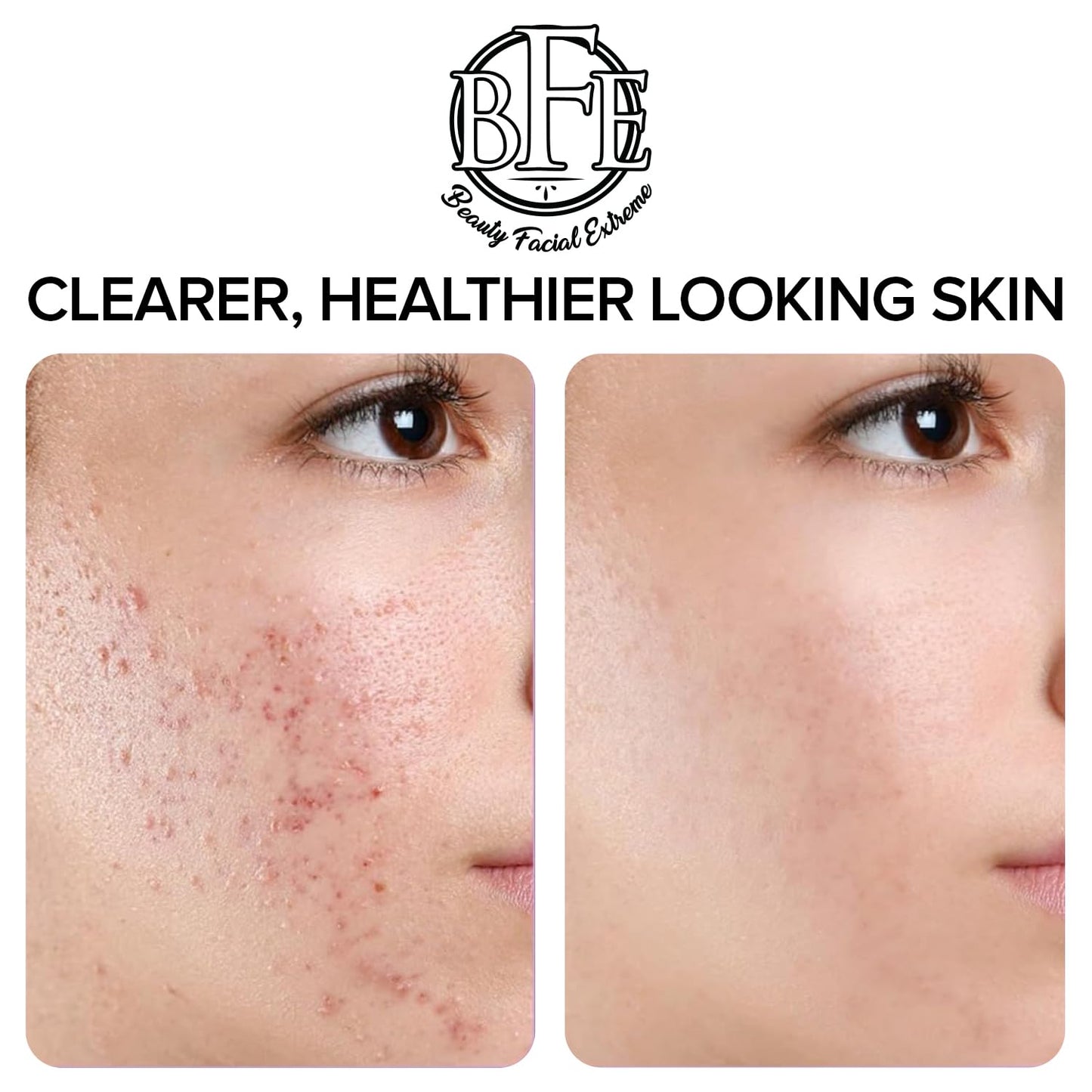Acne Treatment Pads - Clear Cystic Breakouts & Clogged Pores | Improve Skin Texture & Reduce Dark Spots