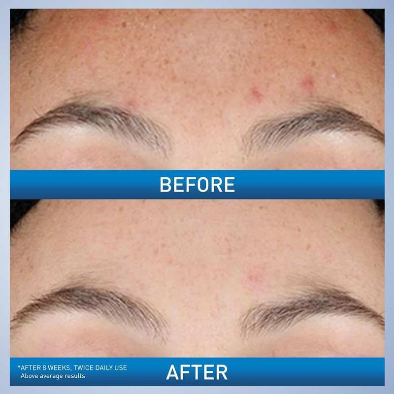 CeraVe Resurfacing Retinol Serum - Brightening Acne Marks Treatment | Niacinamide & Licorice Root Extract