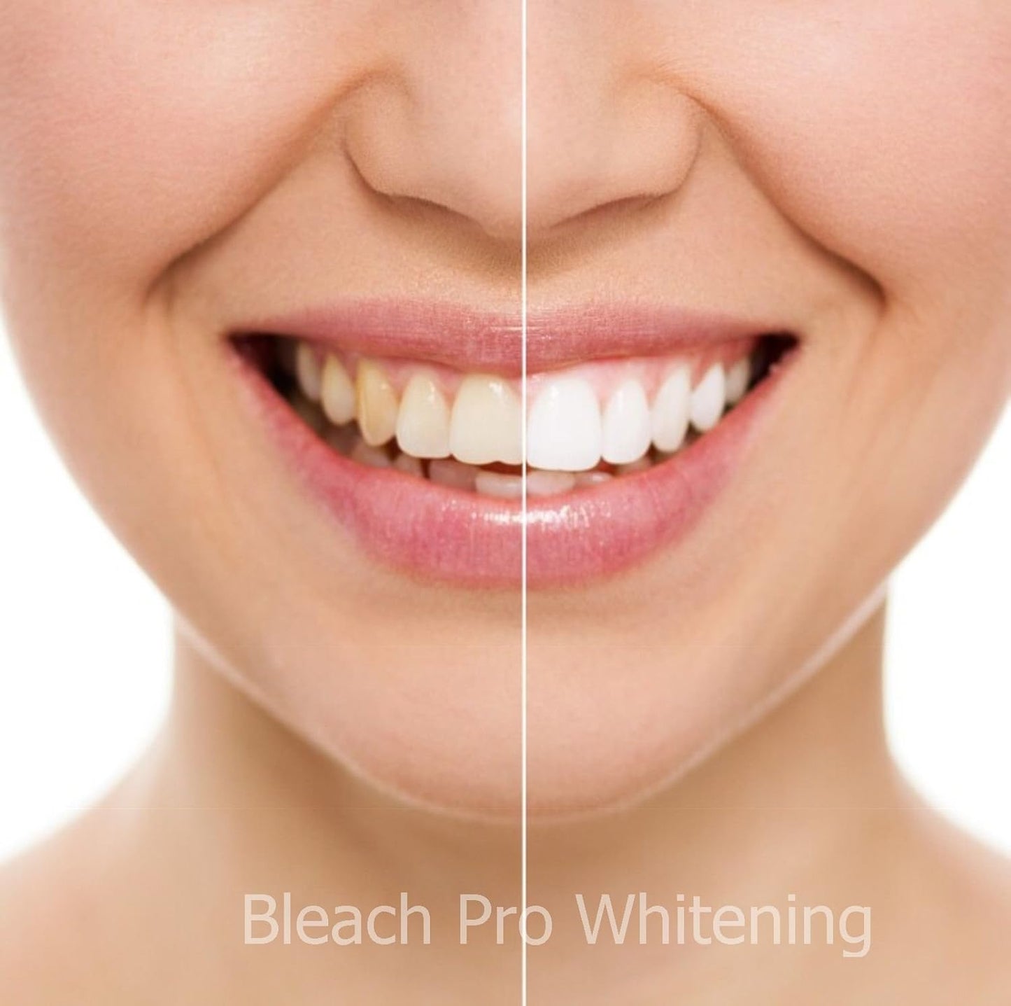Teeth Whitening Gel Syringe Dispensers - 22% Carbamide Peroxide | 10 x 3ml Tooth Bleaching Gel Syringes