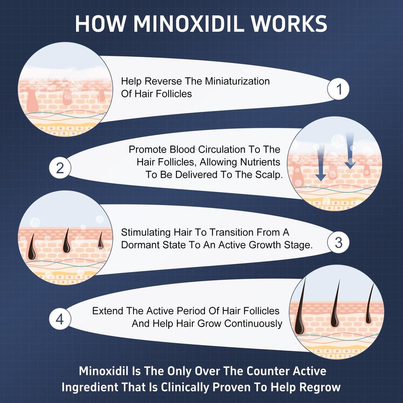 5% Topical Minoxidil Foam, Minoxidil for Men and Women, Infused with Biotin, Hair Growth Treatment, Supports Thicker, Fuller, Healthier Hair & Beard (Foam,6 x 2.11oz,6 Month's Supply)