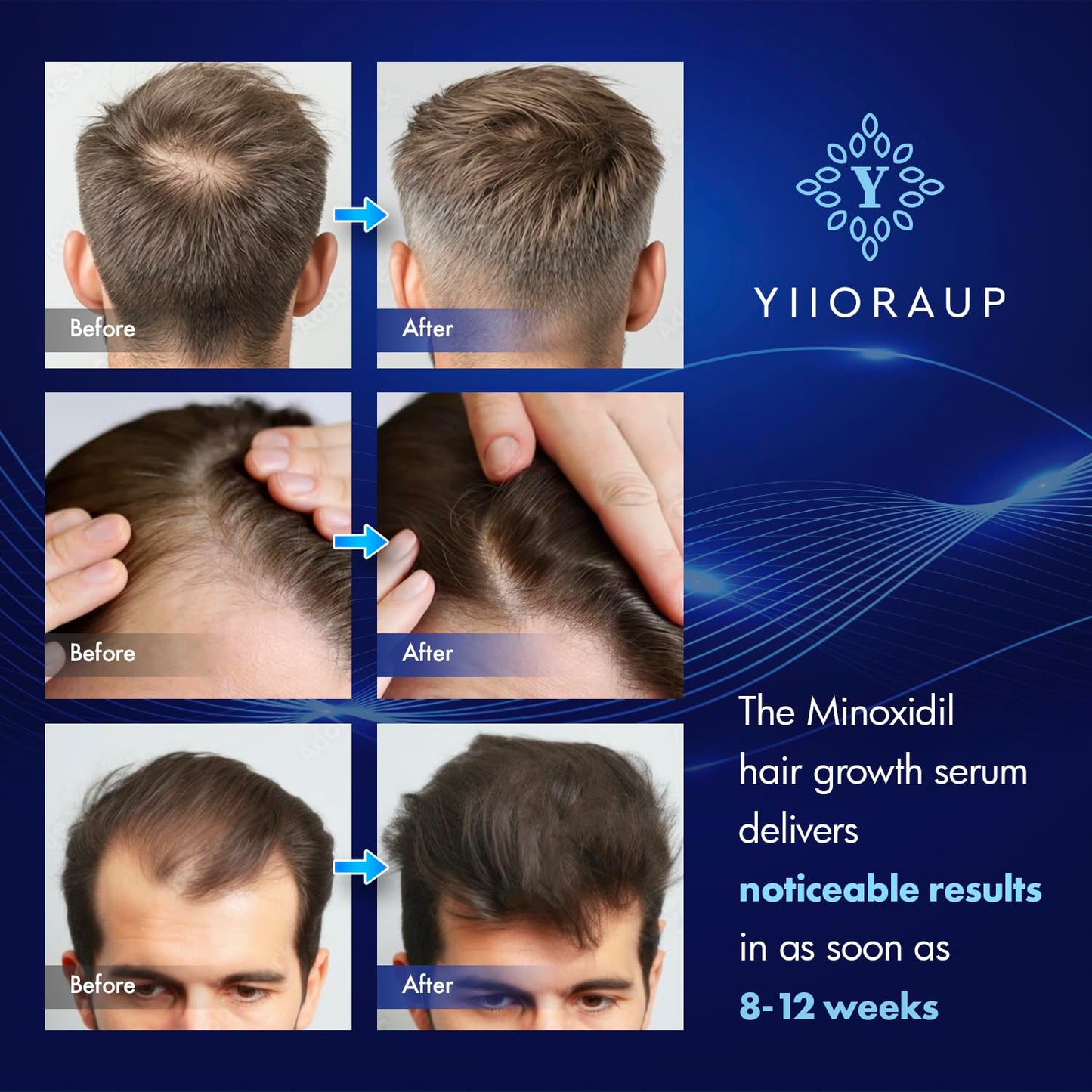 5% Minoxidil Hair Growth for Men and Women: Extra Strength Minoxidil Topical Solution for Adults with Receding Hairlines or Vertex Thinning - Hair Loss Treatment Serum with Biotin for Daily Scalp Use