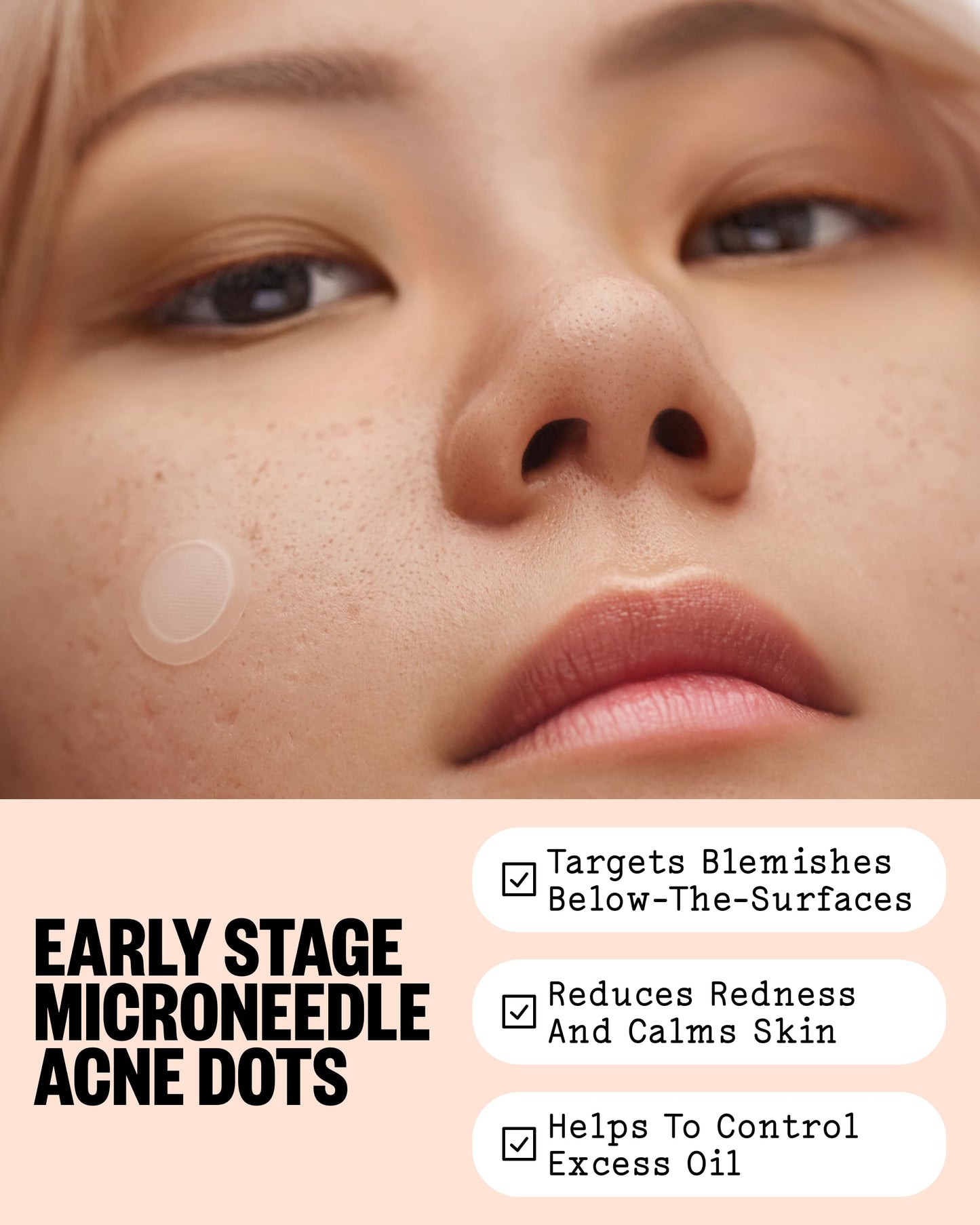 PEACE OUT Early Stage Acne Dots, Microneedling Acne Pimple Patches with 2% Salicylic Acid to Target Blemishes Forming Below the Surface (8 Count)