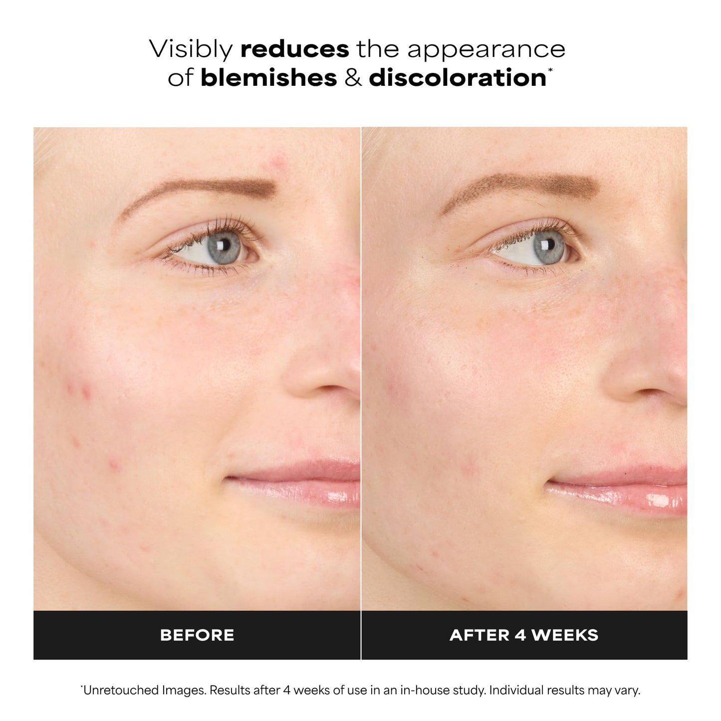 Paula’s Choice BOOST 10% Azelaic Acid Booster Cream Gel, Oil-Free Serum Fades Discoloration & Post-Blemish Marks, with Licorice Extract & Salicylic Acid, Fragrance-Free, 1 Fl Oz