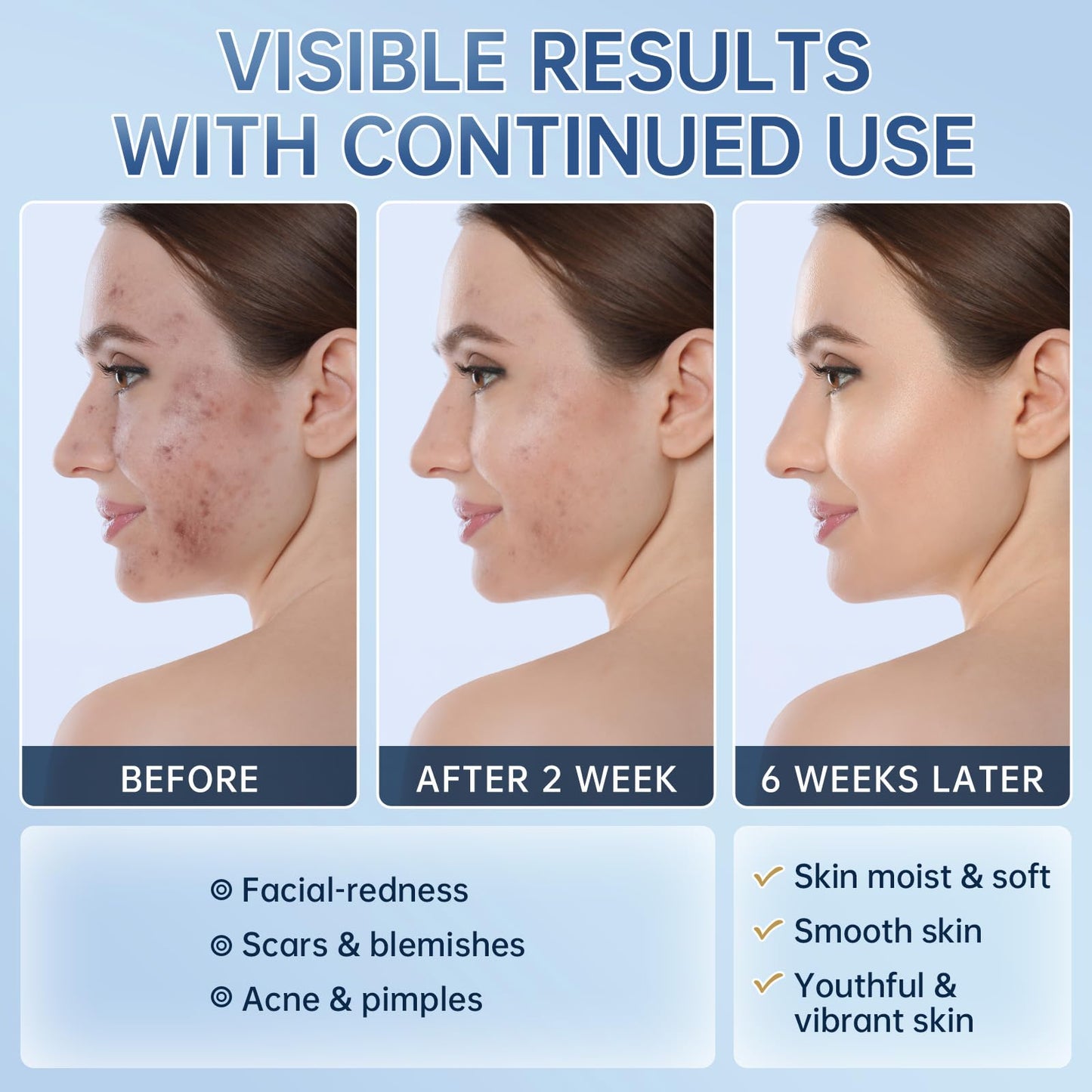 Azelaic Acid 14% Acne Cream for Redness Relief, Dark Spots, Facial Serum with Niacinamide & Vitamin C Prevent Acne Breakouts, Azelaic Acid Serum for Balance Excess Sebum & Soothe Irritation, 2 Oz.