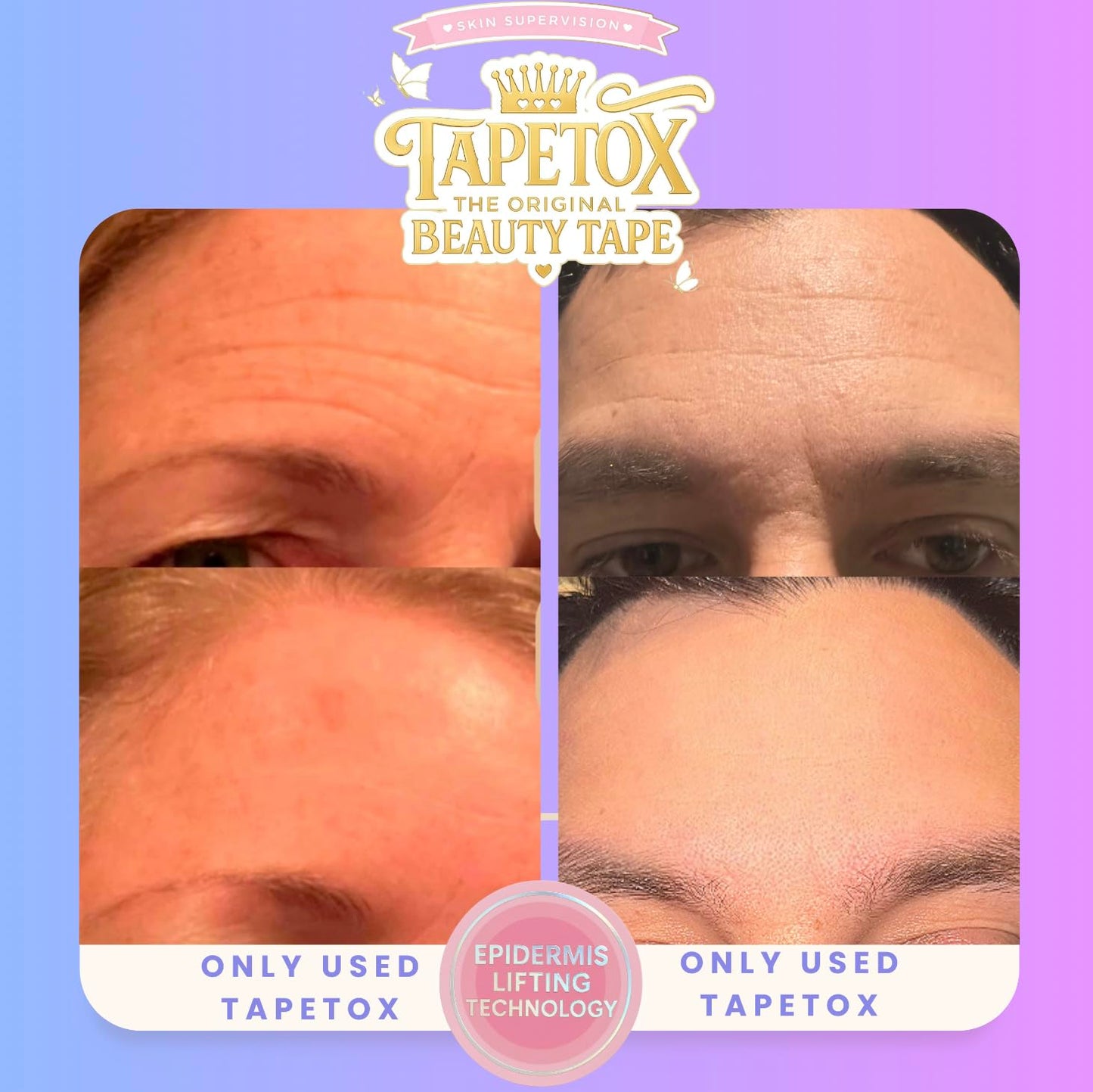 Skin Supervision TapeTox Hearts Face Patches Infused with Wild Yam and Snow Mushroom, Overnight Treatment, 30 Heart-Shaped Patches, for 11 Lines, Smile Lines and Crow's Feet