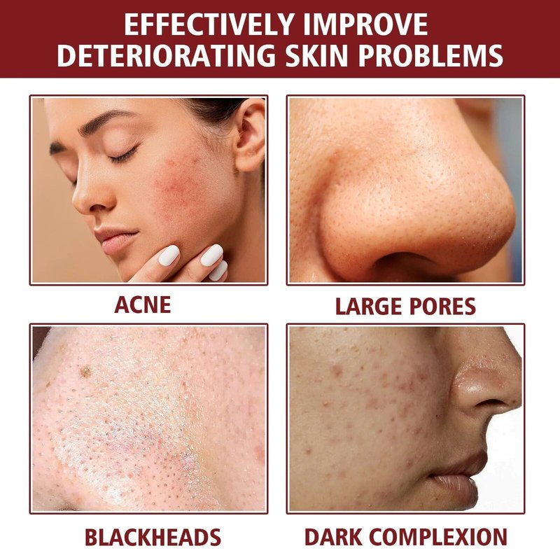 AHA 30% + BHA 2% Peeling Solution, Chemical Peel for Face at Home, BHA Liquid Exfoliant for Large Pores, Wrinkles & Fine Lines, 1.0 FlOz (1 PCS)