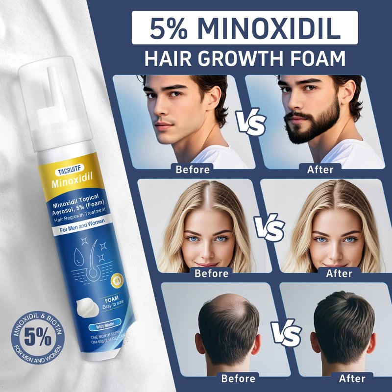 5% Topical Minoxidil Foam, Minoxidil for Men and Women, Infused with Biotin, Hair Growth Treatment, Supports Thicker, Fuller, Healthier Hair & Beard (Foam,6 x 2.11oz,6 Month's Supply)
