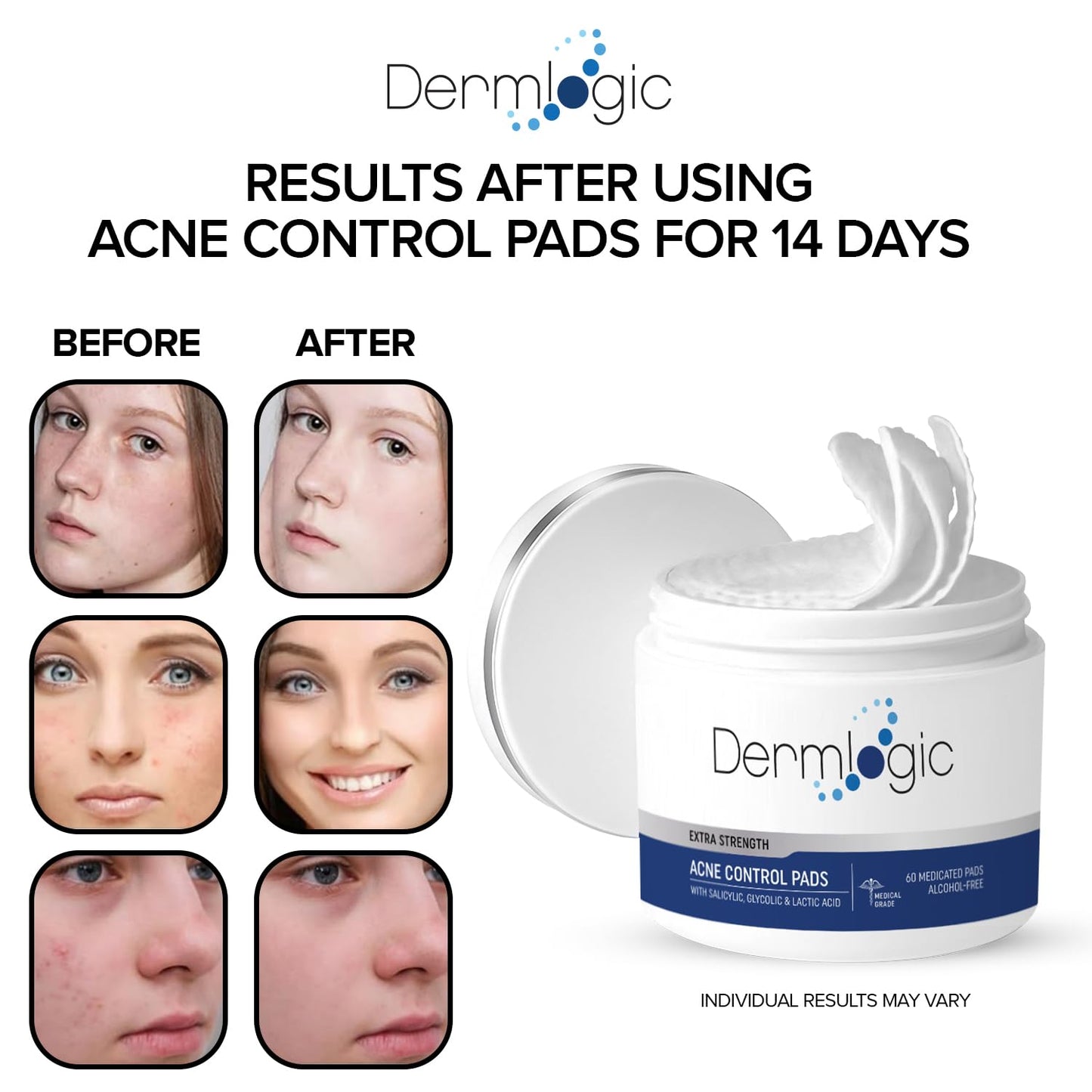 Dermlogic Acne Treatment Pads - Glycolic, Lactic & Salicylic Acid for Oily Skin | Clears Clogged Pores & Breakouts