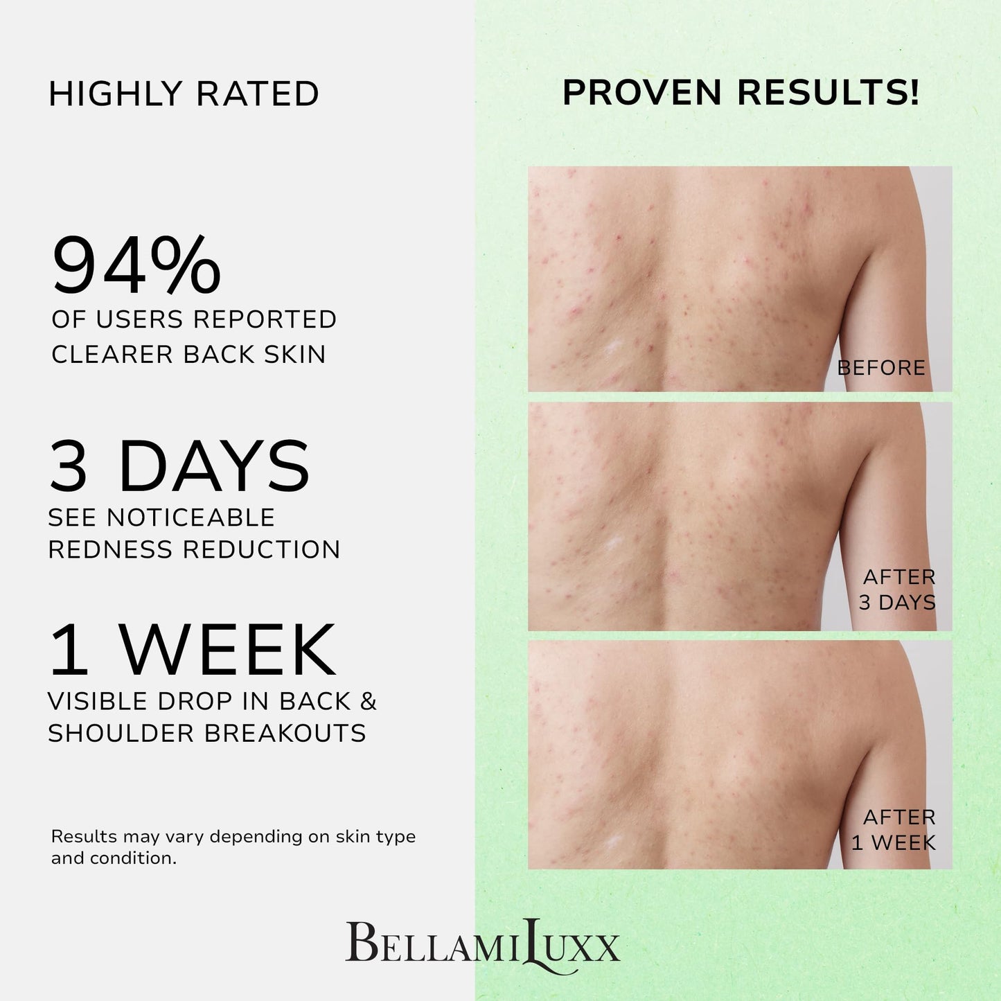 BellamiLuxx Back & Body Acne Treatment: 2% Salicylic Acid Back Acne Spray for Clear, Soothe & Moisturize - Effective Bacne Treatment with Tea Tree Oil, Body Acne Spray for Men, Women & Teens