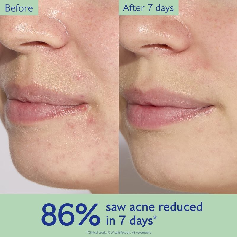 Caudalie Vinopure Acne Treatment, Salicylic Acid Serum to Treat and Prevent Blemishes - 30 mL