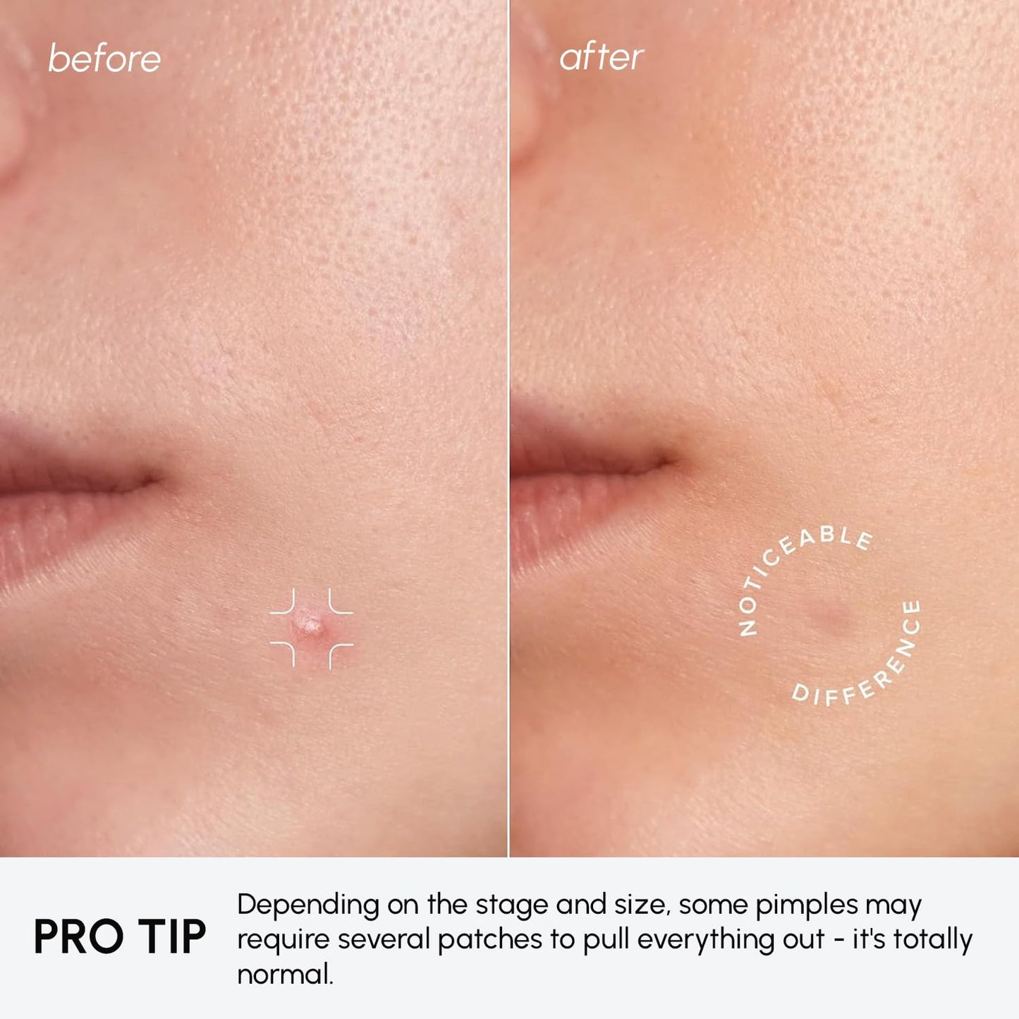 MAREE Star Pimple Patches for Face - Hydrocolloid Acne Patches w/Salicylic Acid, Tea Tree Oil & Centella - Cute Pimple Patches Stars - Teens Zit Patches Stickers - Parches Para Acne - 72 Blemish Dots