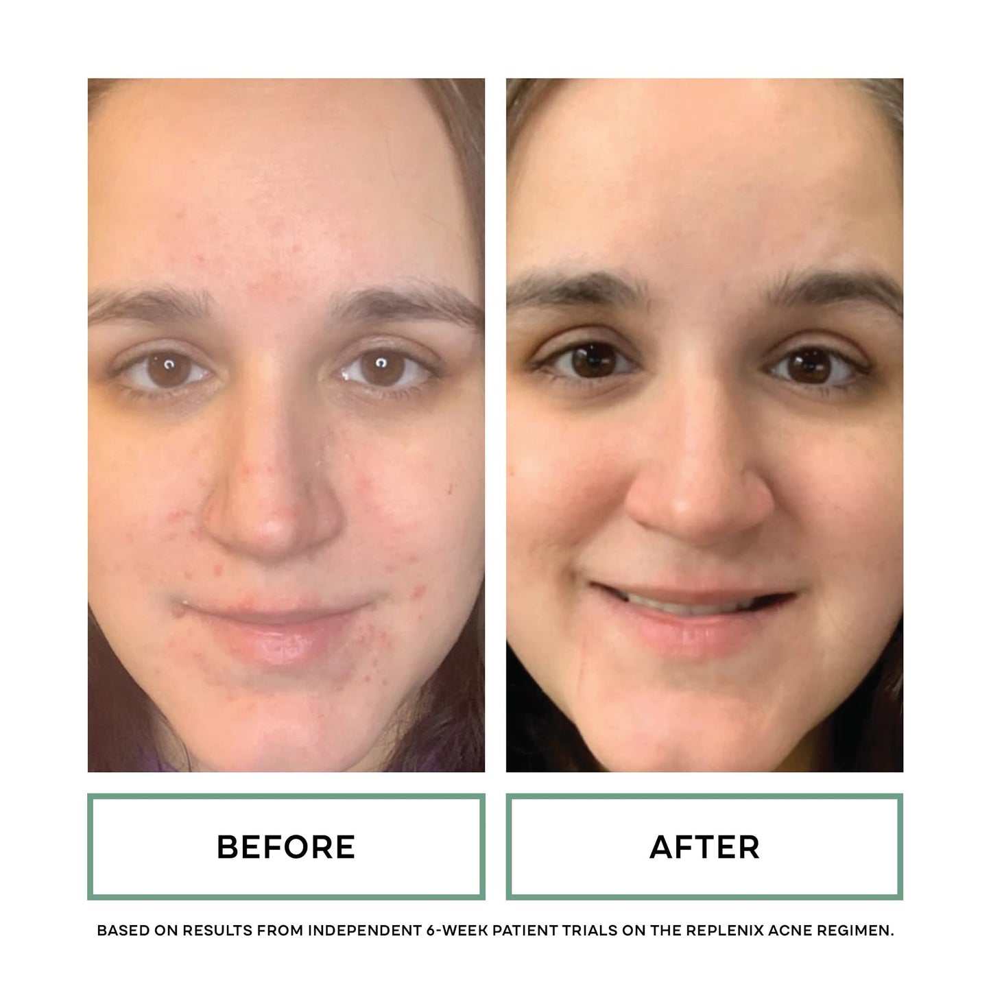 Replenix 10% Benzoyl Peroxide Acne Face Wash with Aloe, 6.7 Fl Oz – Clarifying Acne Treatment Cleanser for Face & Body, Gently Unclogs Pores, Soothes & Clears Breakouts Without Drying