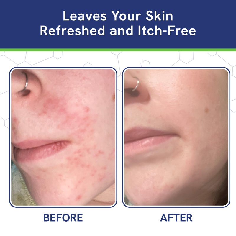 pHat 5.5 Seborrheic dermatitis Moisturizing Cream & Face Lotion for Women - Soothing Redness for Face & Body Cream - Hydrating for Dry Skin & Anti Itch Lotion (8oz)
