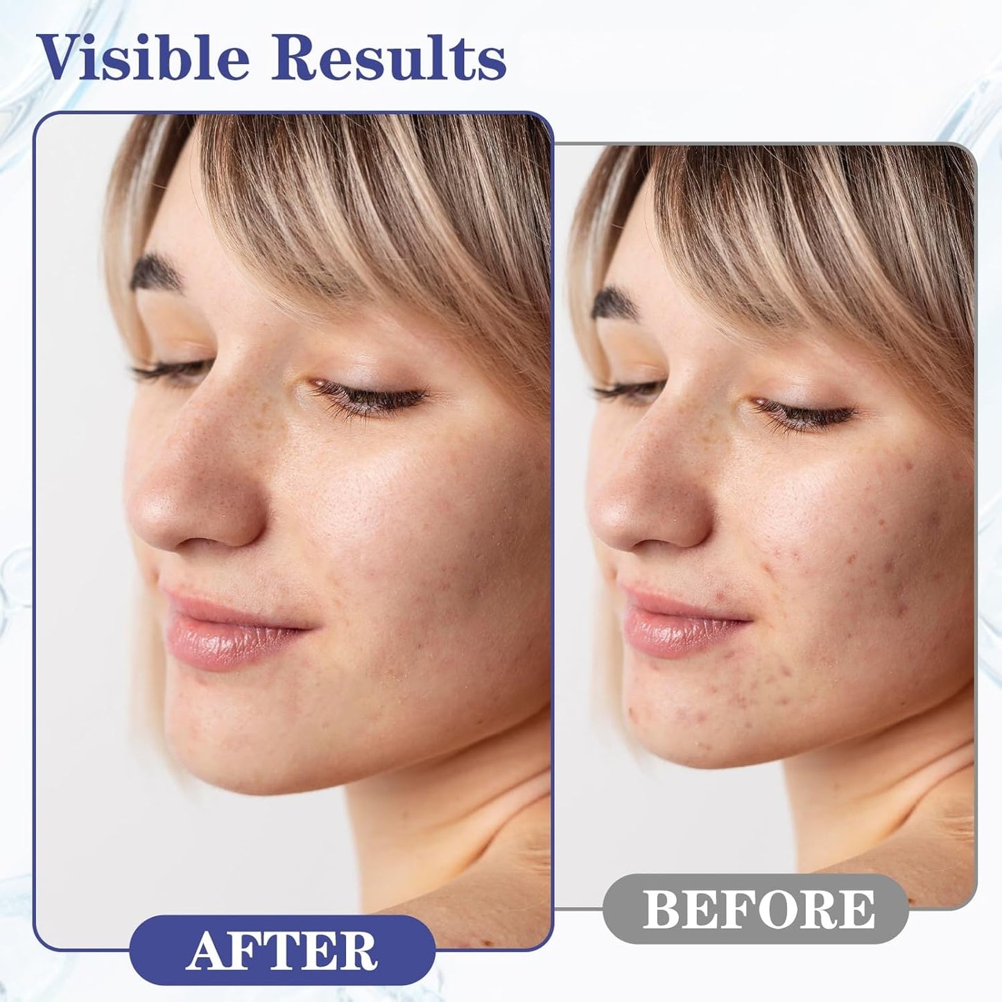 Control Gel with 2% Salicylic Acid & Botanical Extracts - Acne Treatment for Face & Body, Gentle for All Skin, 1.7 FL