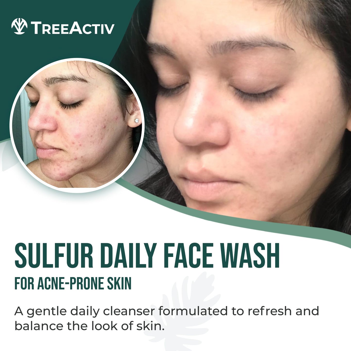 Sulfur 10% Exfoliating Charcoal Acne Face Wash, 8 Fl Oz, Face Wash for Men & Women, Sulfur Acne Wash for Acne, Activated Charcoal & Pumice, Foaming Daily Women & Men's Face Wash