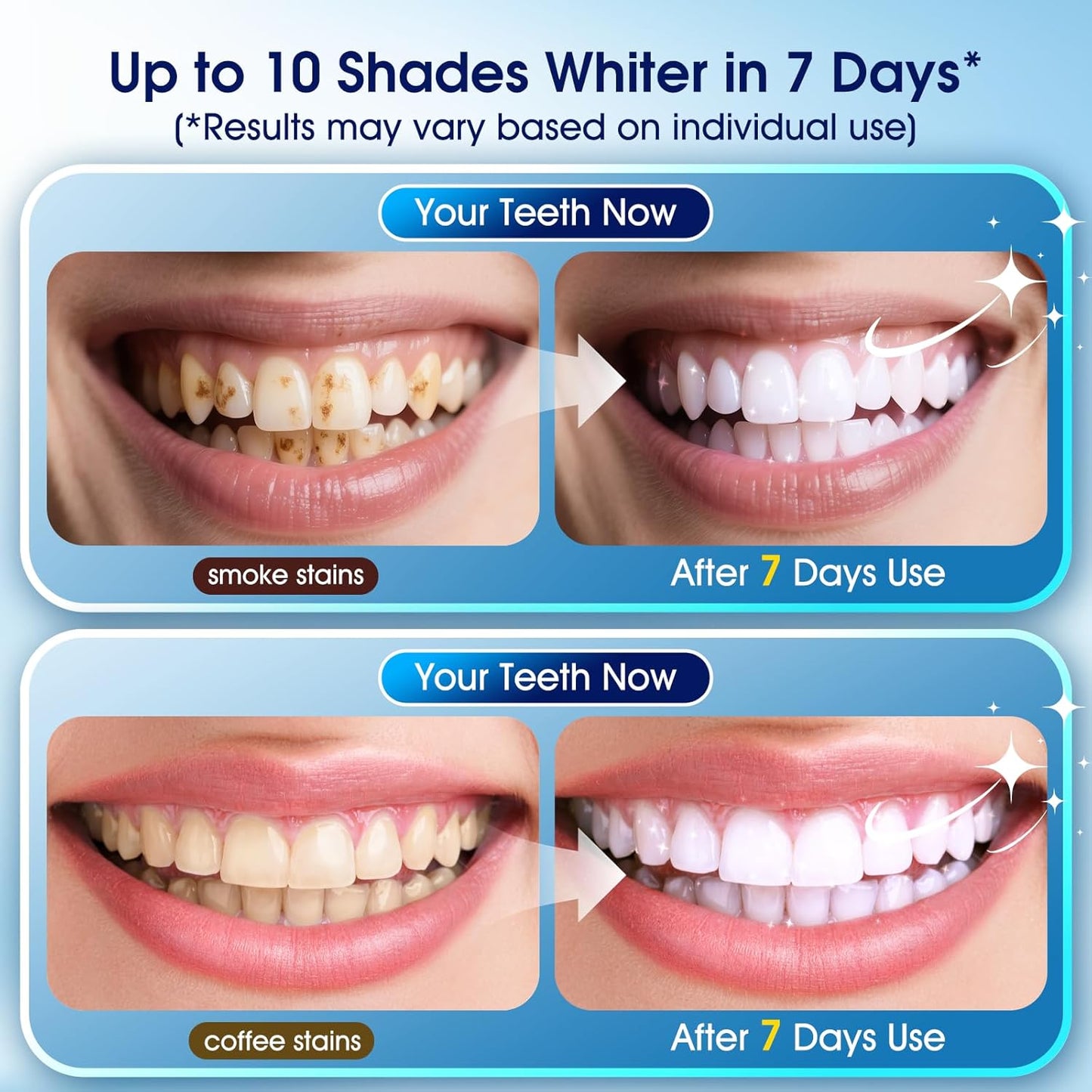 Teeth Whitening Kit with LED Light | 3 Gel Pens & 2 Desensitizing Pens | Safe for Sensitive Teeth, 0.68 Fl Oz (Cherry)