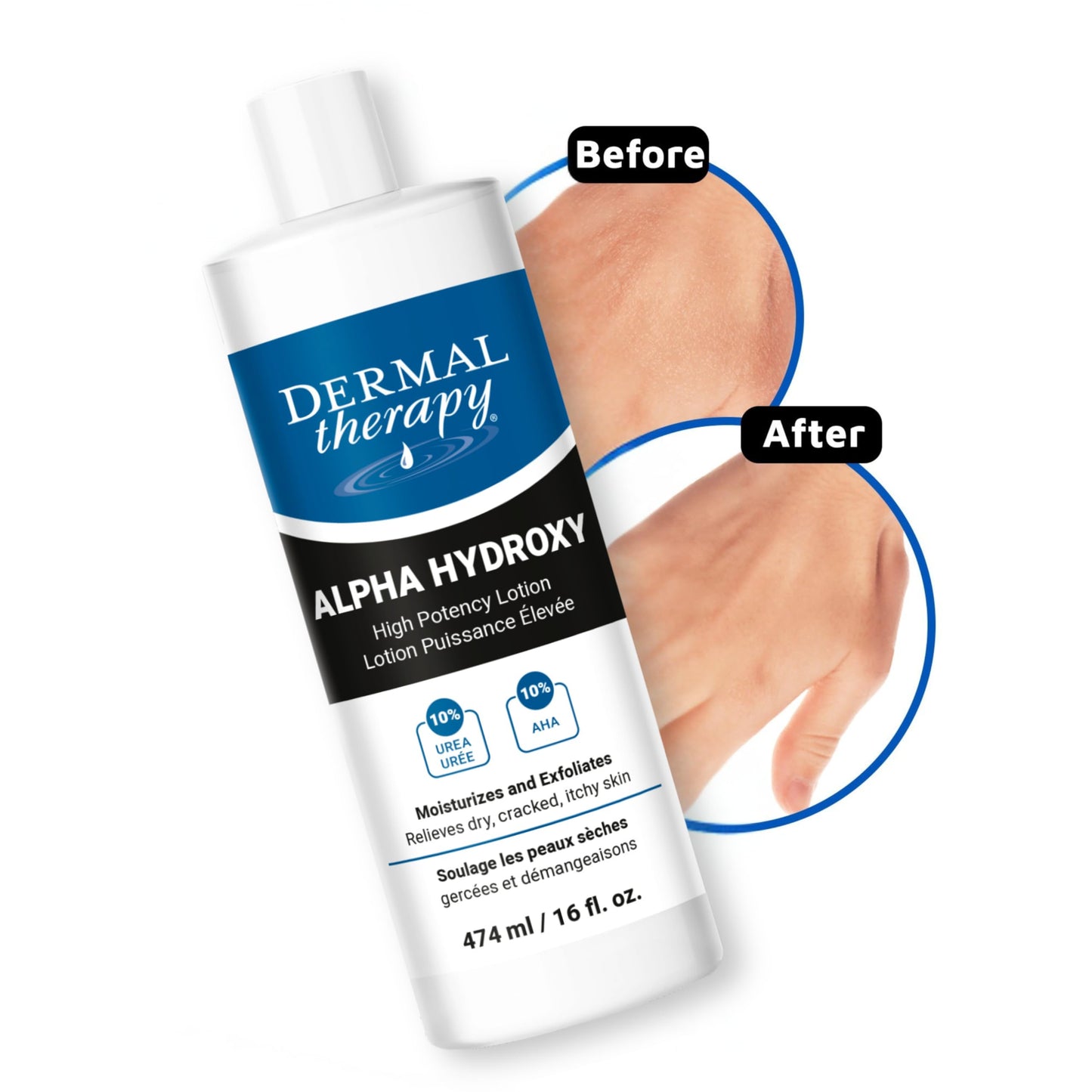 Dermal Therapy Alpha Hydroxy Lotion – 10% Urea + 10% Lactic Acid, Fragrance-Free Body Lotion for Dry, Cracked Skin, Non-Greasy Exfoliating Moisturizer & Keratosis Pilaris Treatment, 16 fl oz (474 ml)