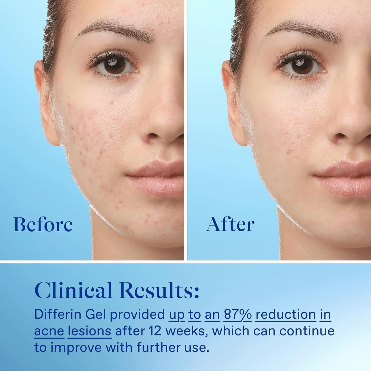 Differin Acne Treatment Gel - 0.1% Adapalene Retinoid for Acne Prone Skin | 15g Tube