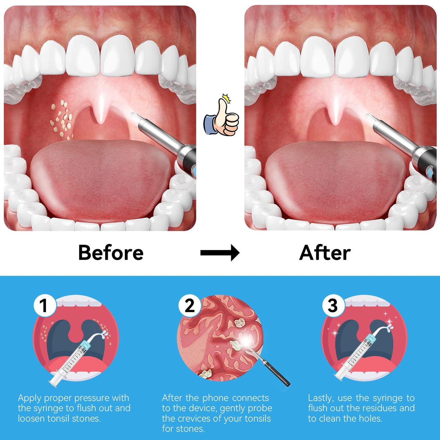 Upgraded Tonsil Stone Remover with Camera, Visual Tonsil Stone Removal Kit with 6 LED Light, Tonsil Stone Removal Tool Camera with 1080P, 5 Head Attachments, for iOS & Android (White)