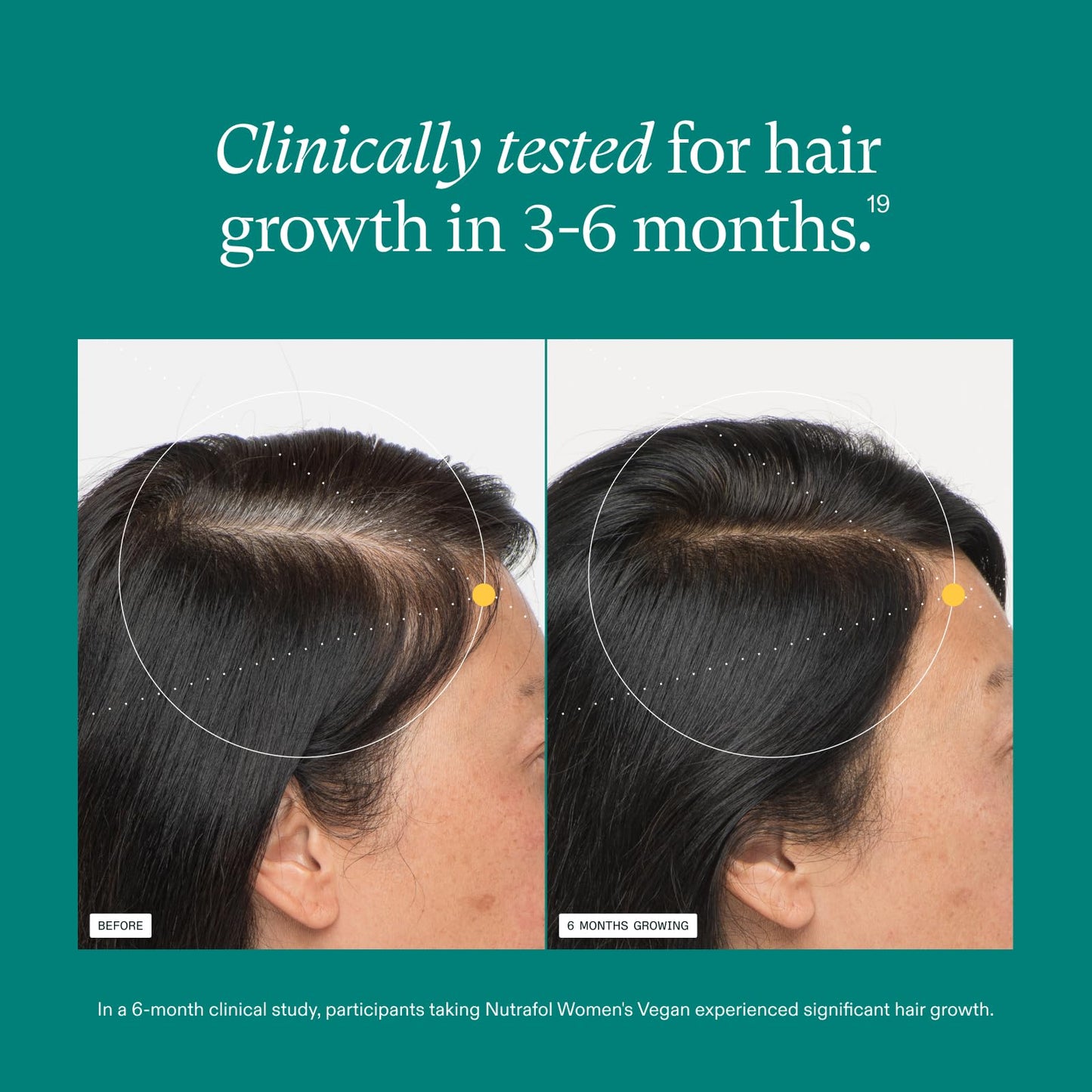 Nutrafol Women's Hair Growth Supplements and Hair Serum, Women 18-44 Years Old, Clinically Tested for Visibly Thicker, Stronger Hair, 100% Vegan Ingredients, Dermatologist Recommended - 1 Month Supply