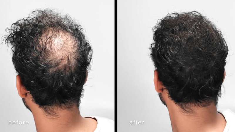 LUXE Hair Building Fibers - Thickening Fibers for Fuller Hair - Hypoallergenic & Dermatologist Tested | Dark Brown, 2-Month Supply