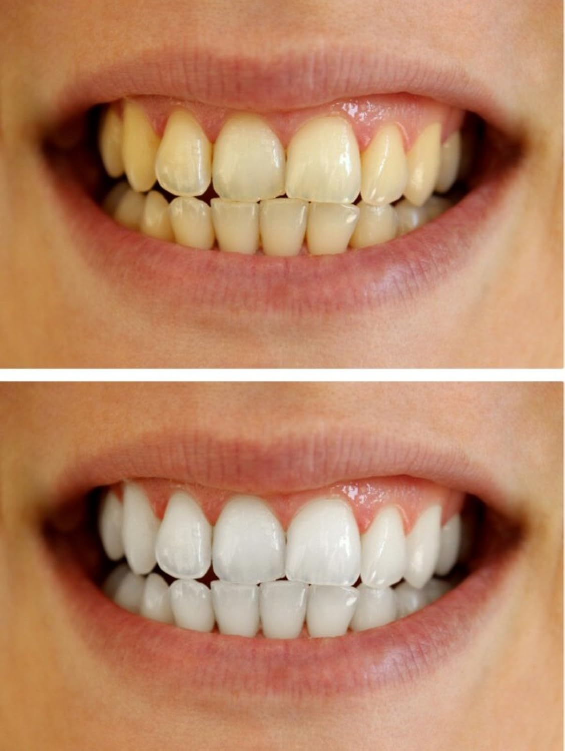 Teeth Whitening Gel Syringe Dispensers - 22% Carbamide Peroxide | 10 x 3ml Tooth Bleaching Gel Syringes