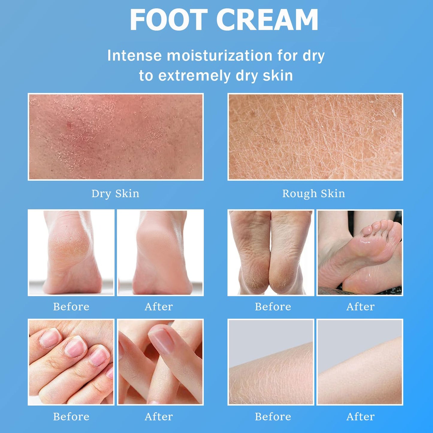 Urea Cream 60% - Urea Foot Cream with Moisturizing Heel Socks for Dry Cracked Hands Heels, 60 Percent for Feet Maximum Strength with 2% Salicylic Acid, Jojoba Oil, Aloe Vera, 5.31oz (Blue, 5.3oz)