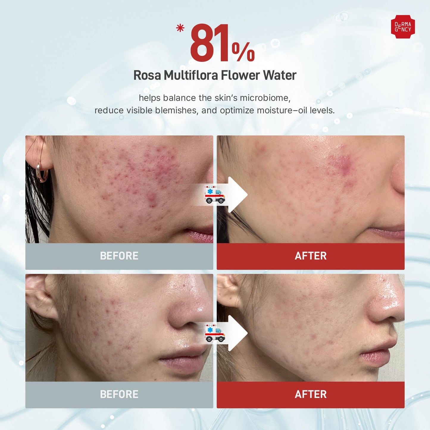DERMAGENCY Zeroca 81 Cream | Korean Acne Cream for Sensitive & Oily Skin | Lightweight, Non-Greasy, Calming Hydration | Oil Control, Pore Refining, Cica | Fragrance-Free | K-beauty 2.02 Fl.Oz / 60ml
