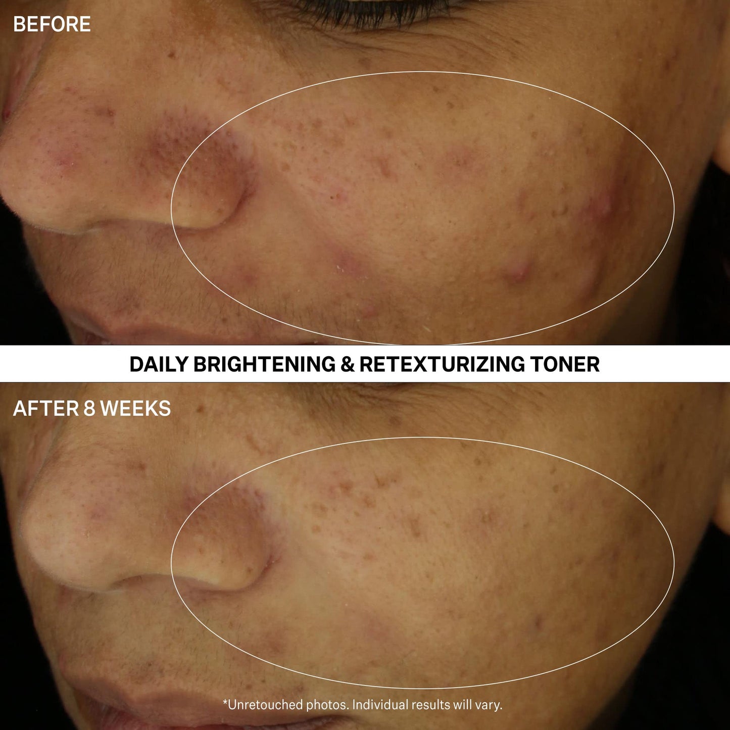 StriVectin Multi Action Clear Daily Brightening & Retexturing Toner for Acne and Blemish Prone Skin for Clearer, Smoothening and Brightening, Less Breakouts and Pimples for Healthy Looking Face