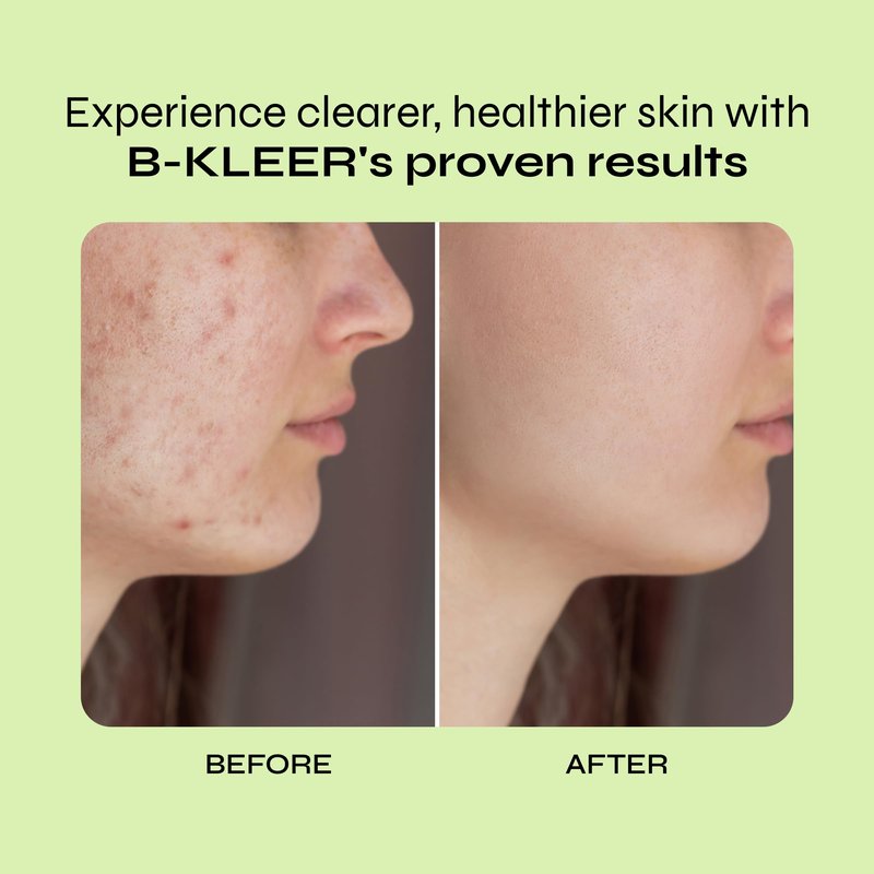 A-Cute Derm B-Kleer Cleansing Gel Acne Cleanser that Purify and Protect Your Skin from Clogged Pores for All Skin Types (8oz)