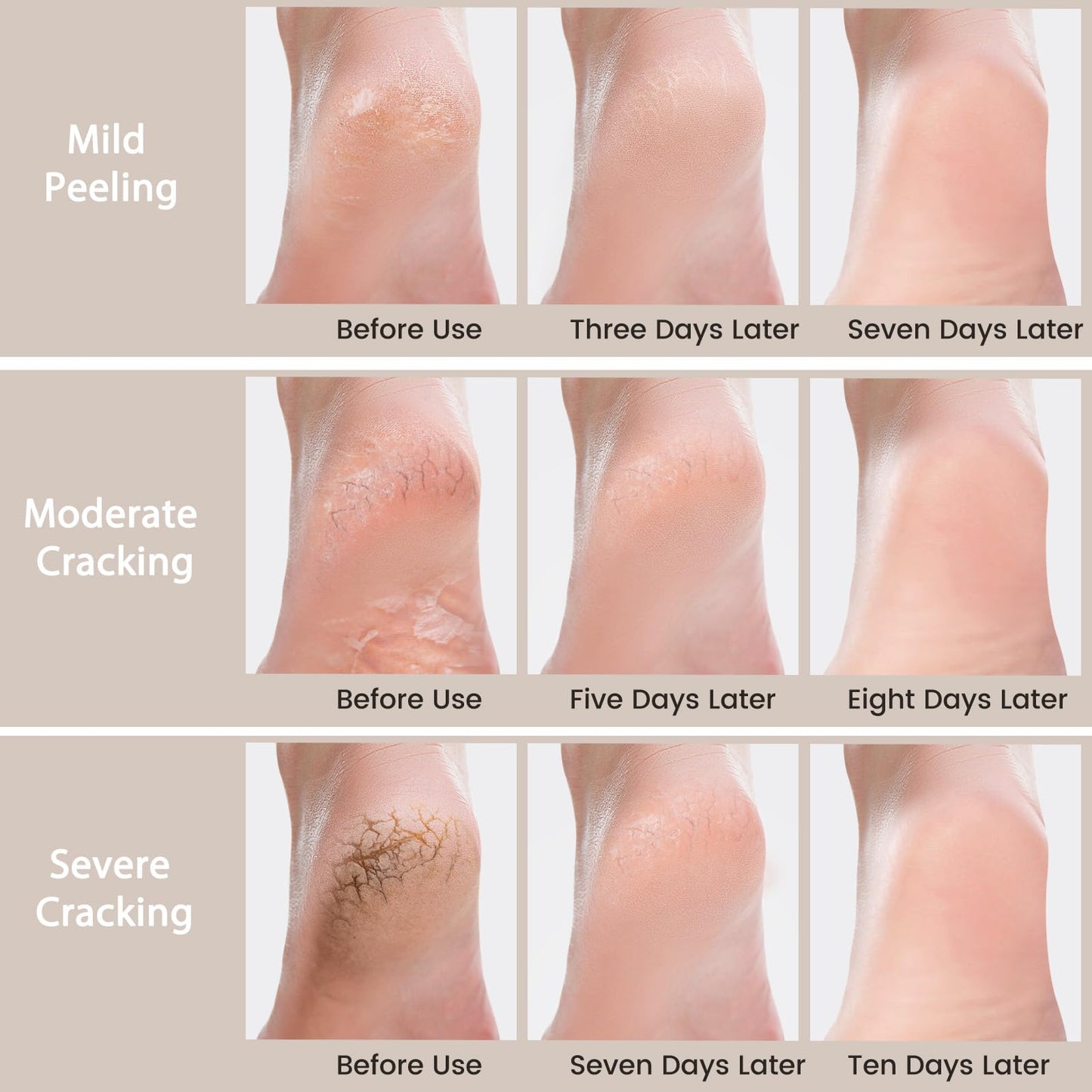 Mouriven 3 Packs Urea Cream 40 Percent - Foot & Hand Cream, for Dry, Cracked Heels, Feet, Knees, Elbows, and Hands, Callus Remover, Maximum Strength Urea Lotion for Softening and Moisturizing