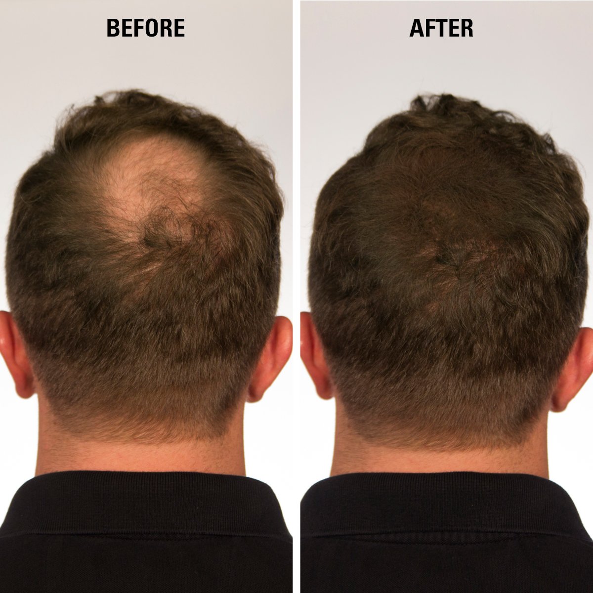 INFINITY Hair Fibers Black for Thinning Hair for Women & Men - 100% Undetectable Hair Building Fiber Powder - Conceal Hair Loss in 15 Seconds, 30g