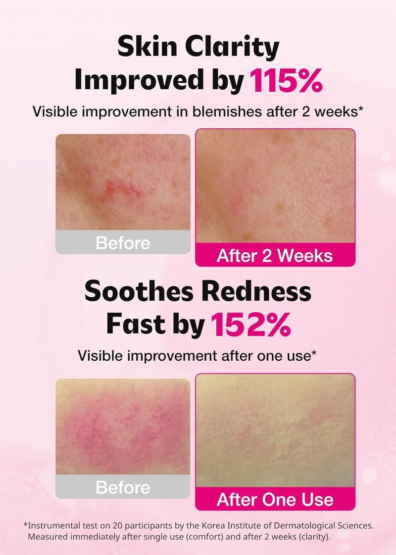 ISOI Blemish Care Serum - Vegan Hydrating Formula for Smooth Glass Skin | 1.18 fl. oz (35ml)