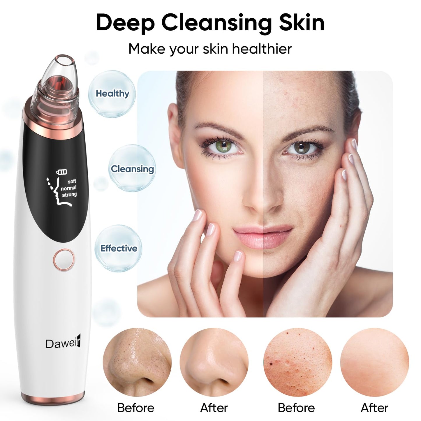 Blackhead Remover Pore Vacuum (Snow White)