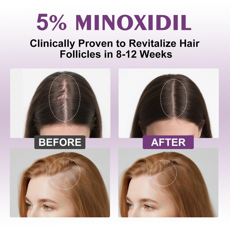 5% Minoxidil Spray for Women-Free minoxidil applicator included，monoxide for men hair Infused with Biotin, hers hair regrowth treatment, Supports Thicker and Fuller Hair & Beard (13oz, 7 Month Supply)