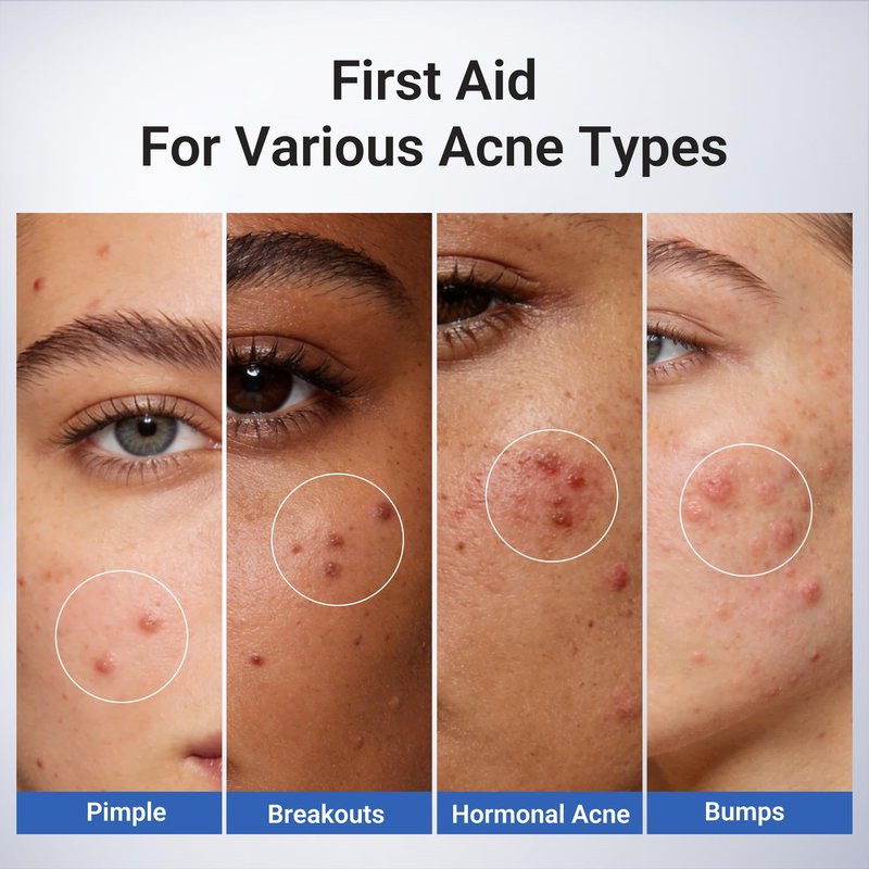 Dr.Leo 1.8% Salicylic Acid Acne Treatment, Drying Lotion Acne Spot Treatment for Acne-Prone Sensitive Skin | Niacinamide, Fast Pimple Relief, Fades Acne Marks, Overnight & Period Breakouts, 0.34 fl oz