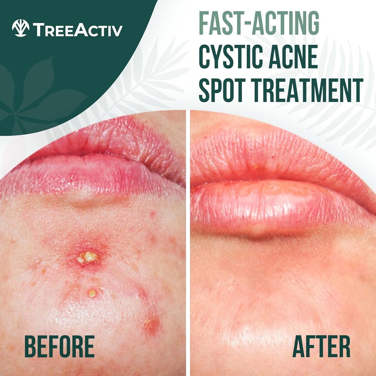 Cystic Acne Spot Treatment Paste - Sulfur & Tea Tree Oil | 0.5 oz for Deep Breakouts