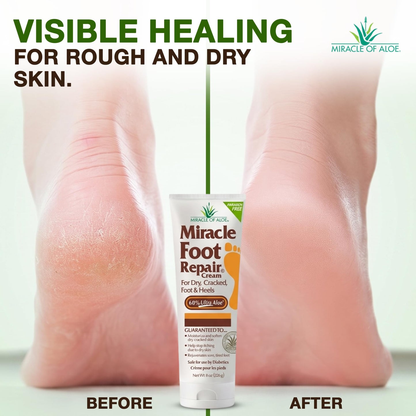 Miracle Foot Repair Cream (8 oz / 2-Pack) Repairs Dry Cracked Heels and Feet, 60% Pure UltraAloe Moisturizes, Softens, and Repairs