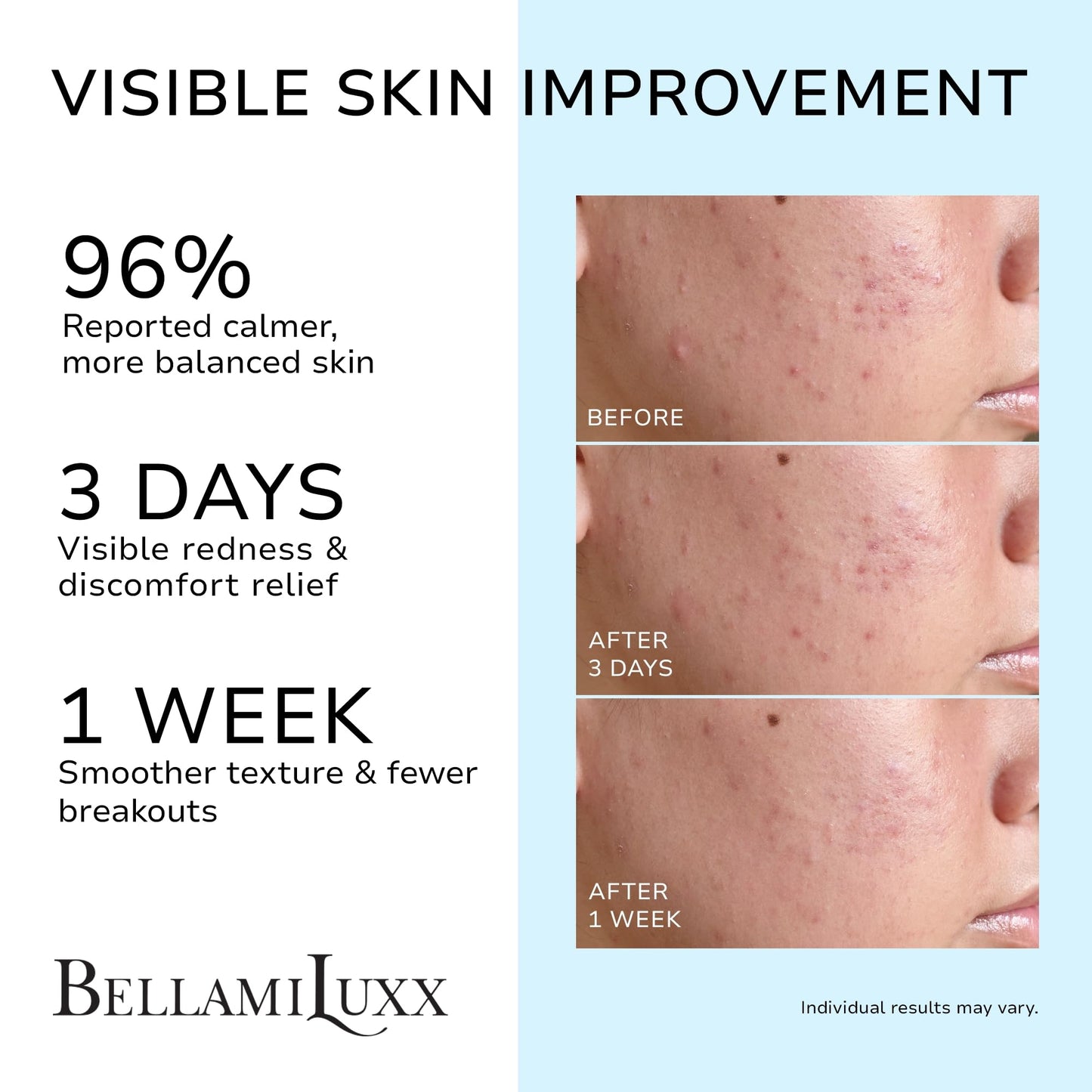 BellamiLuxx Cystic Acne Treatment for Face: Hormonal Acne Treatment Cream for Teens & Adults - Salicylic Acid & Tea Tree Oil Pimple Spot Remover - Anti-Acne Moisturizer Reduces Redness, Blemishes
